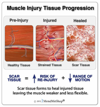 muscle tissue scar injury healing pain stages soft pulled strain massage repair hamstring therapy when treatment graston adhesion happens muscles